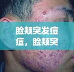 脸颊突发痘痘,脸颊突然起痘痘怎么回事