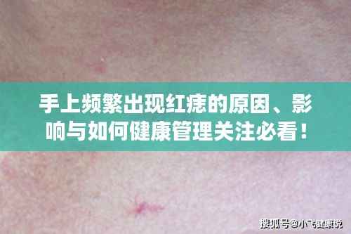 手上频繁出现红痣的原因、影响与如何健康管理关注必看!