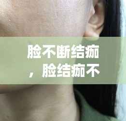 脸不断结痂,脸结痂不掉怎么办