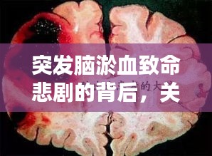 突发脑淤血致命悲剧的背后,关于脑溢血的深度警示与探讨